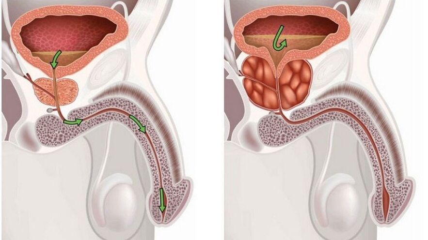 Prostatitis bij mannen