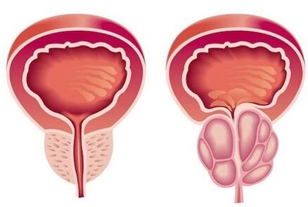 Symptomen van prostatitis bij mannen